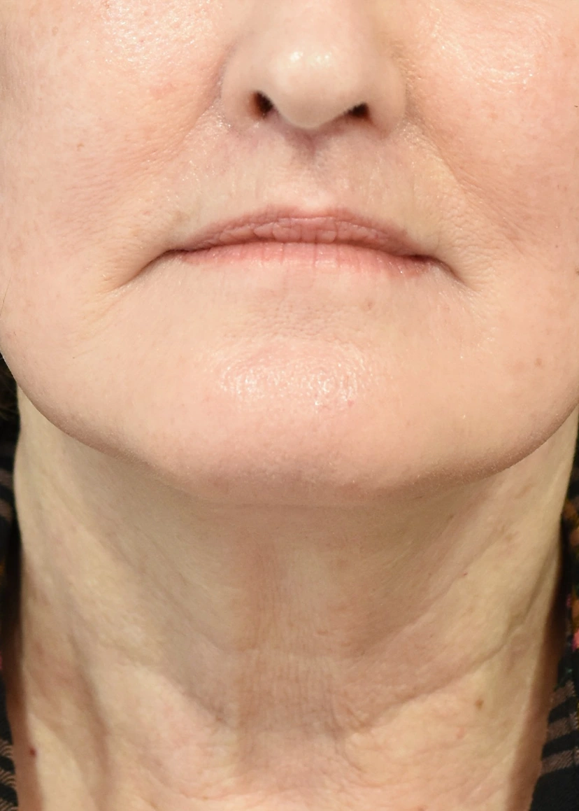 Deep Plane Facelift Patient 36 Set 1 After