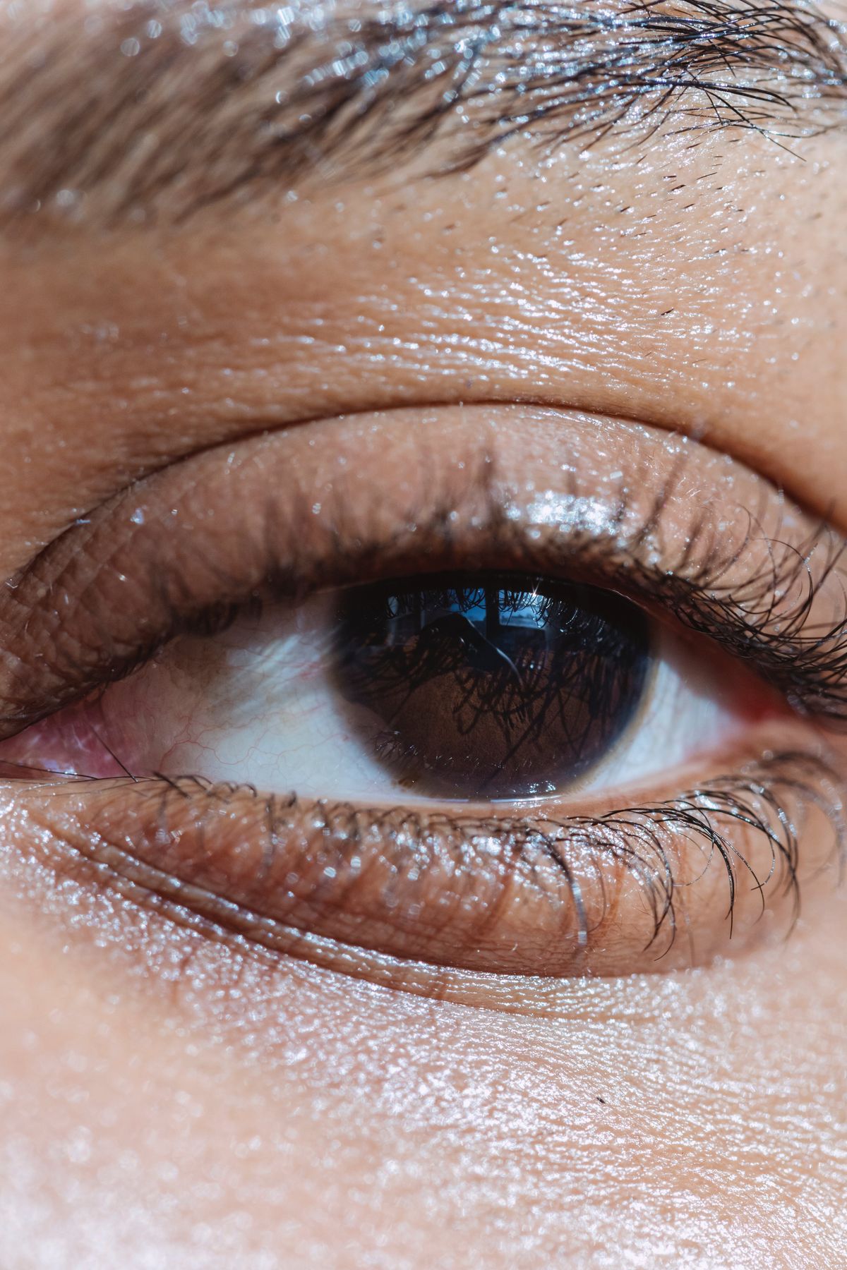 Lower Eyelid Botox® i.e., “Jelly Roll” Botox: Is it Safe and Effective?